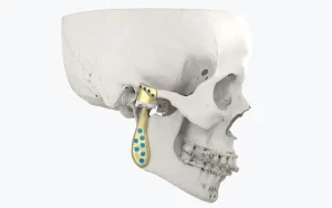 cranio maxillofacial temporomandibular personalized implant