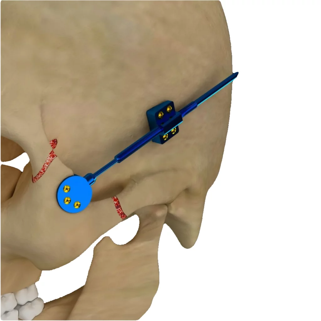 Distração osteogênica ()