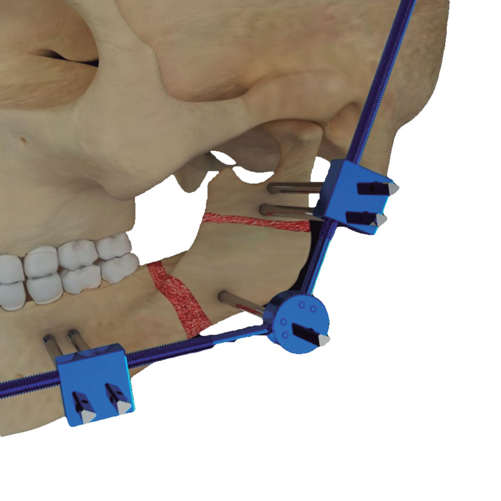 Distração osteogênica ()