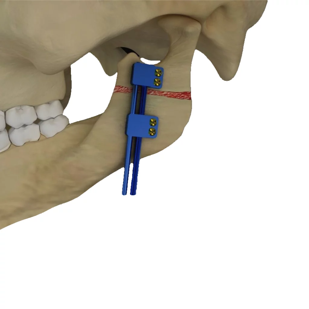 Distrator unidirecional intraoral