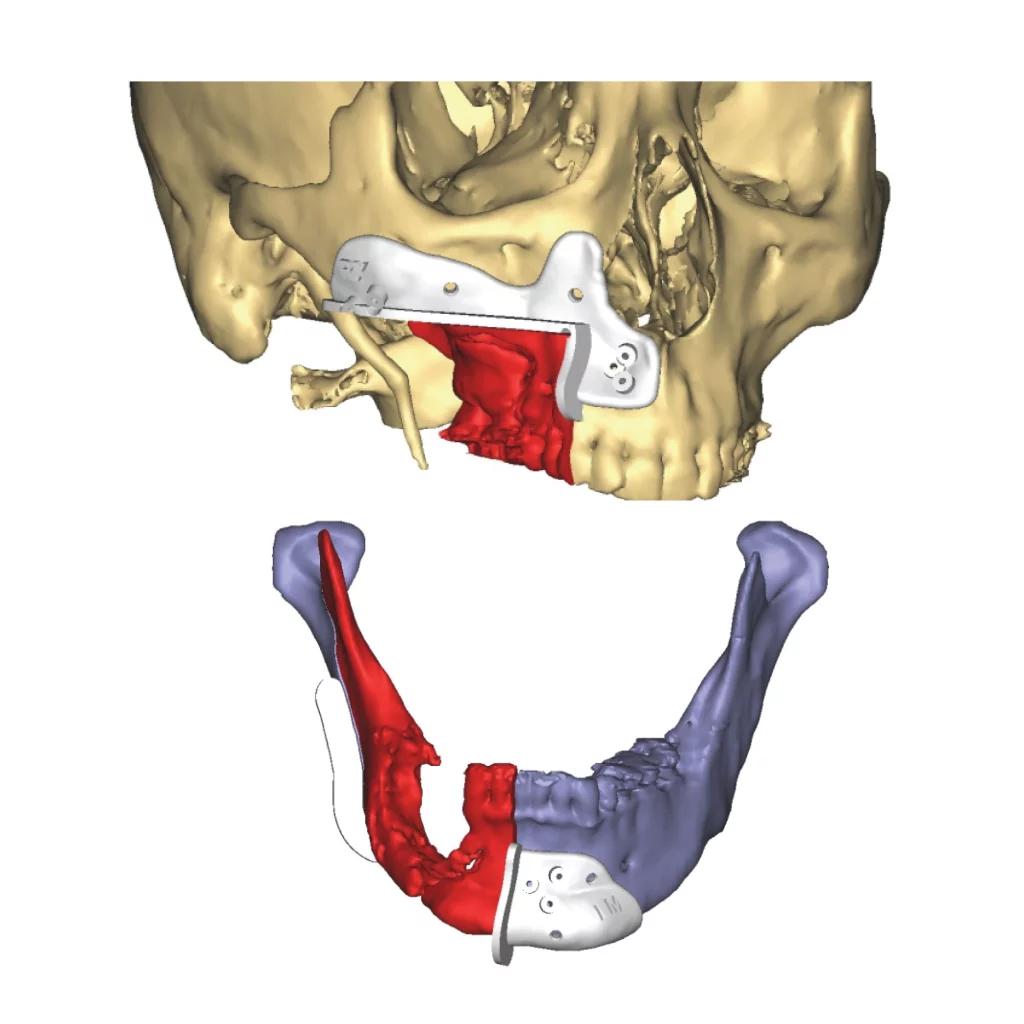 Guias de osteotomia personalizados